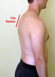 Flat back syndrome Figure 1b