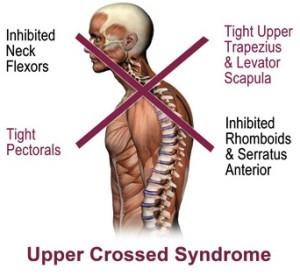 Upper cross syndrome Figure 3