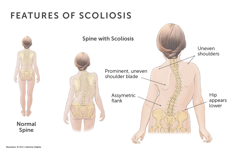 scoliosis6.png
